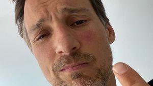 Aua! Florian David Fitz zeigt fiesen Wespenstich im Gesicht