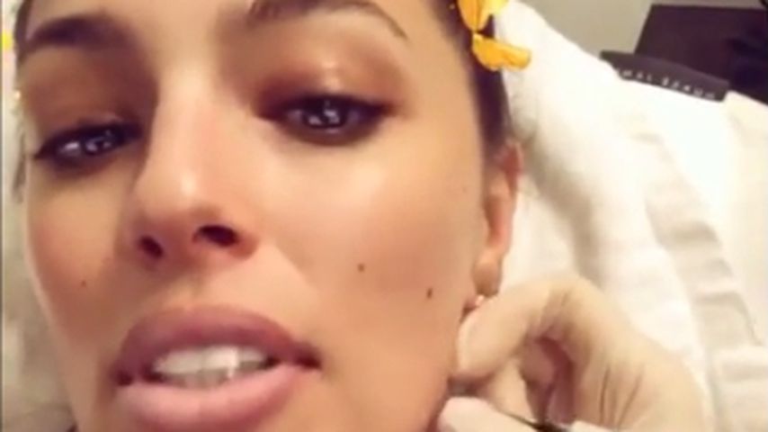 Warzen-Entfernung: Curvy-Model Ashley Graham brutal ehrlich!