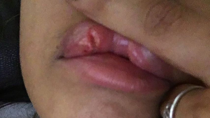 Die aufgeplatzte Lippe von "Geordie Shore"-Star Zahida Allen