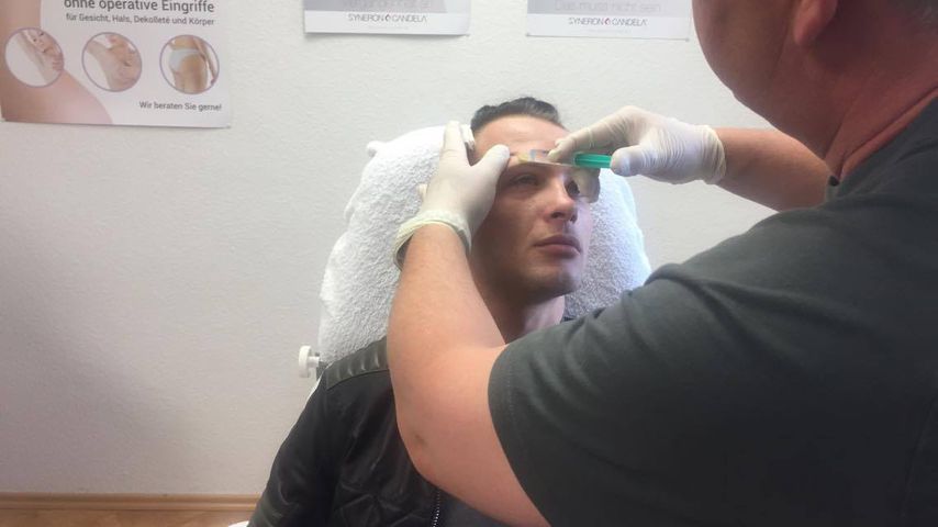 Krasser Schmerz! "Supertalent"-Emil ließ sich Botox spritzen