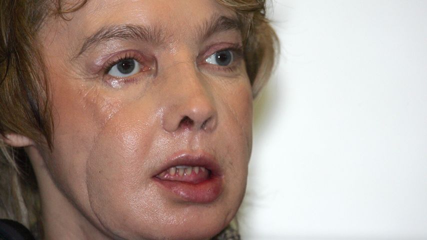 Isabelle Dinoir, erster Mensch mit transplantiertem Gesicht