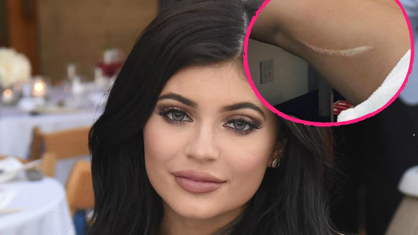 Beim Versteck-Spiel: Daher kommt Kylie Jenners XXL-Narbe