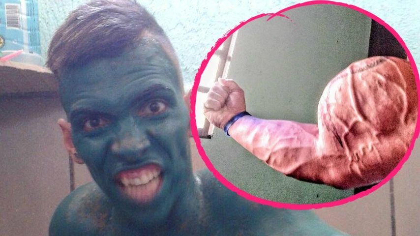 Skurriler Mucki-Body: Real-Life-Hulk verlor fast seinen Arm