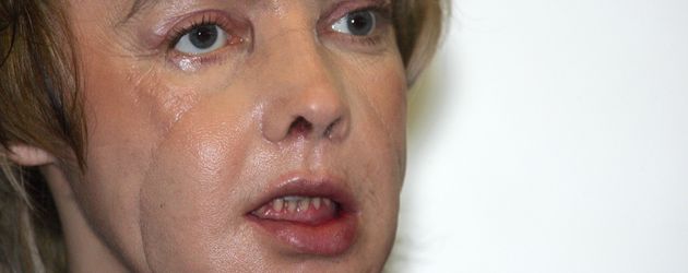 Isabelle Dinoir, erster Mensch mit transplantiertem Gesicht Isabelle Dinoir, erster Mensch mit transplantiertem Gesicht